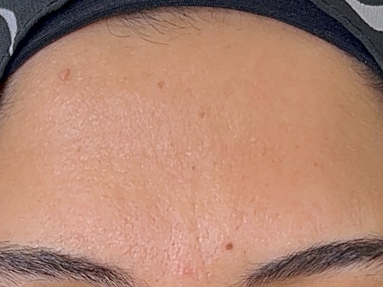 علاج Botox للجبين